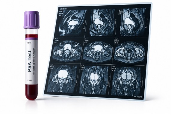 psa test and imaging